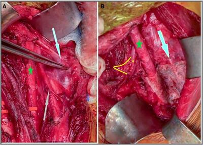 Clinico-pathological initial outcome of a newly adopted novel surgical technique for nodal metastatic thyroid cancer at a large-volume centre in a high-income developing country